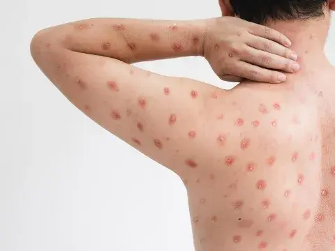 Pierwszy przypadek małpiej ospy w Polsce – co musisz wiedzieć?